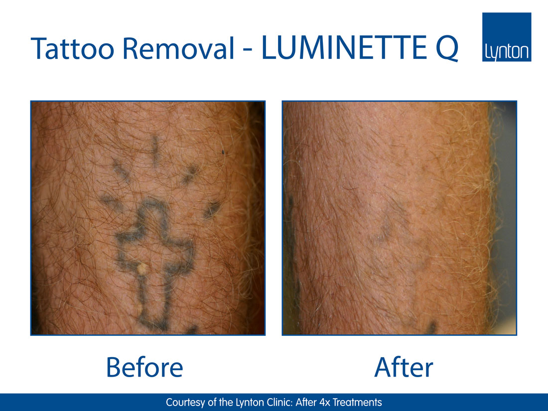 Laser Tattoo Removal - Lux Laser and Beauty Clinic